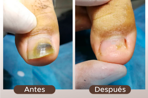 Tratamientos Efectivos para Hongos