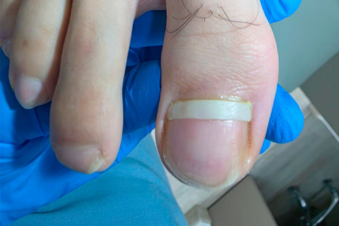 Corrección del Crecimiento y Reconstrucción de la Uña