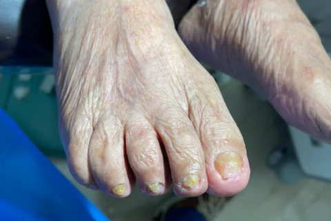 Podología Para Pie Diabético