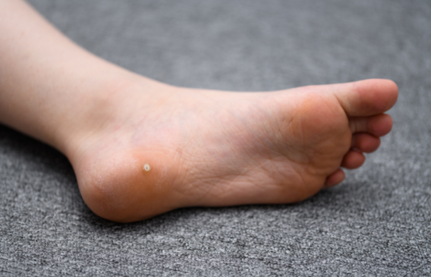 ¿Tienes un «Ojo de Pescado»? Cómo eliminar las Verrugas Plantares de forma definitiva